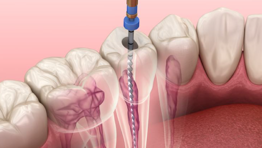 endodoncia